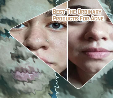 The ordinary for blackheads